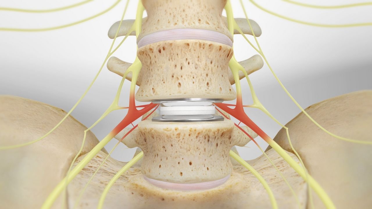 5 Benefits of Total Disc Replacement Surgery