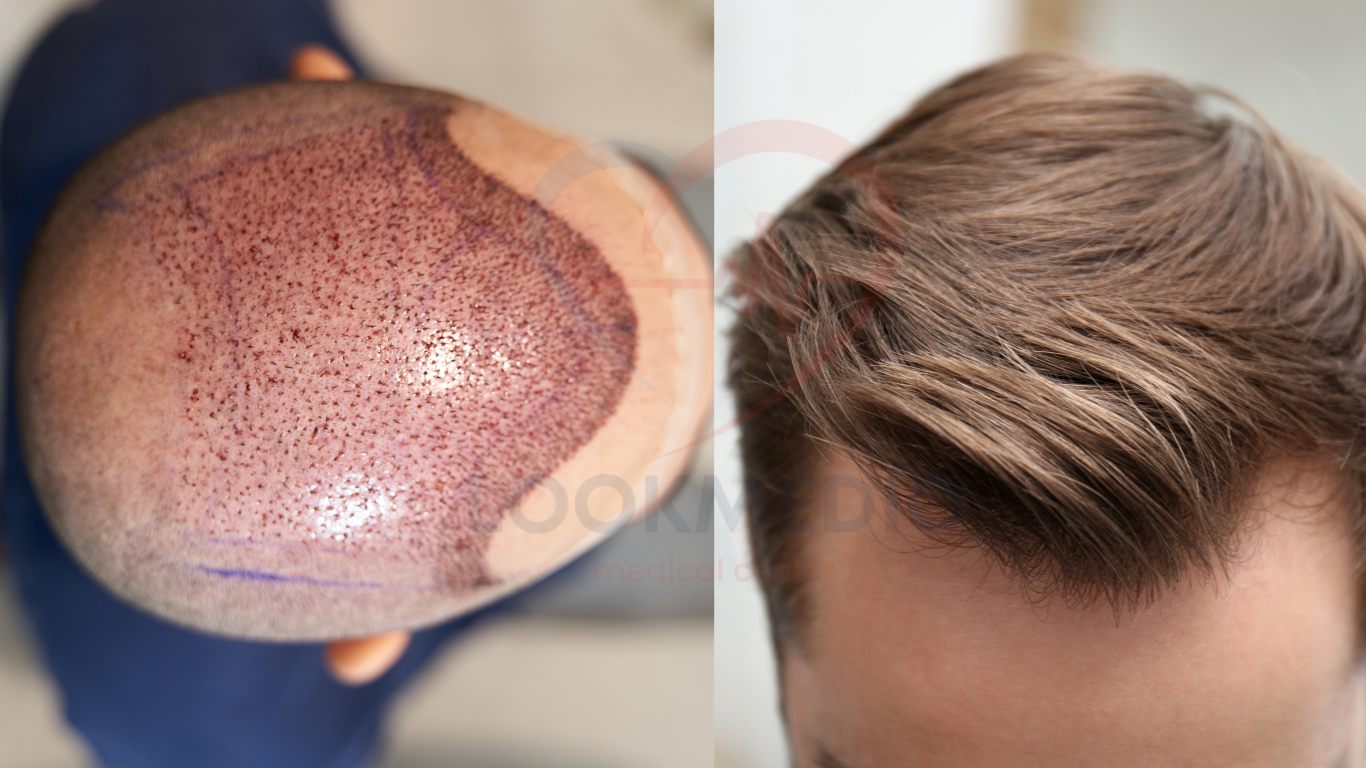 Hair Transplant in Turkey: Achieve Natural Results with Expert Care