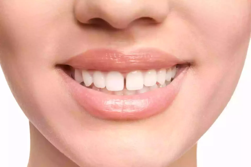 Tooth Gaps