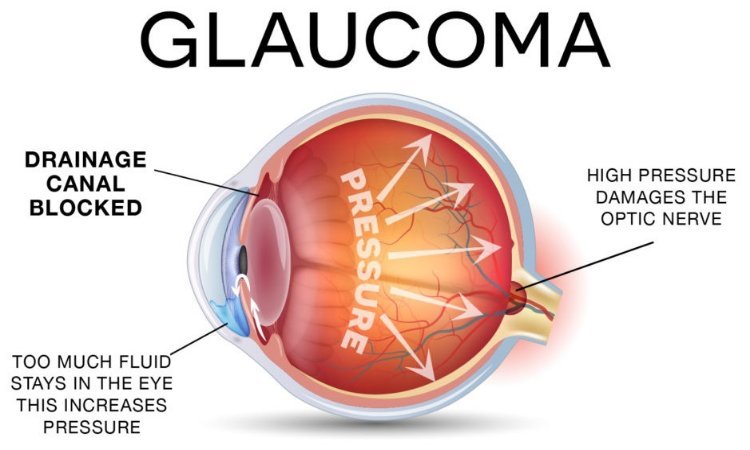 Glaucoma Surgery