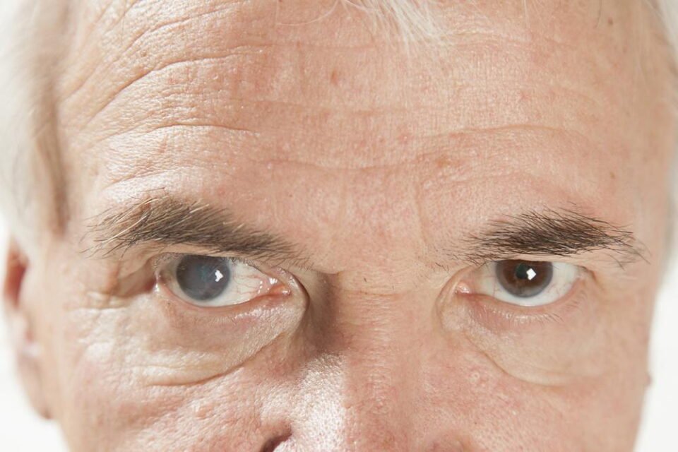 Glaucoma